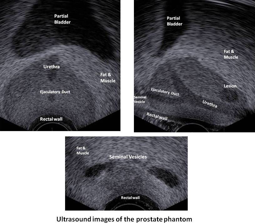 Ultrasound Images of the Prostate phantom